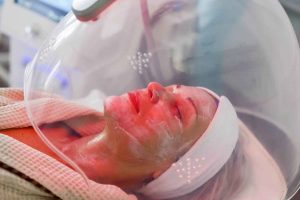 Does Red Light Therapy Help Acne