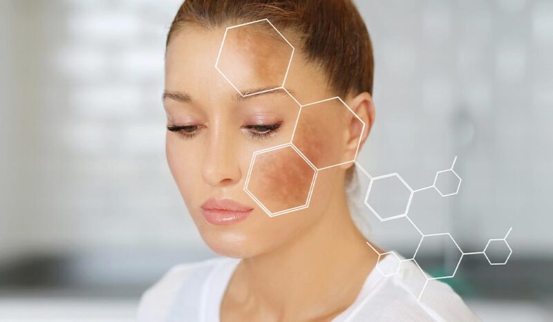 does red light therapy make hyperpigmentation worse