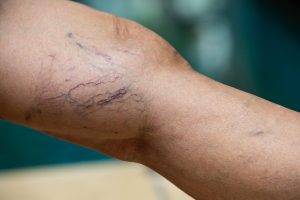 Can Red Light Therapy Help Spider Veins?