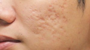 Does Red Light Therapy Help Old Scars?