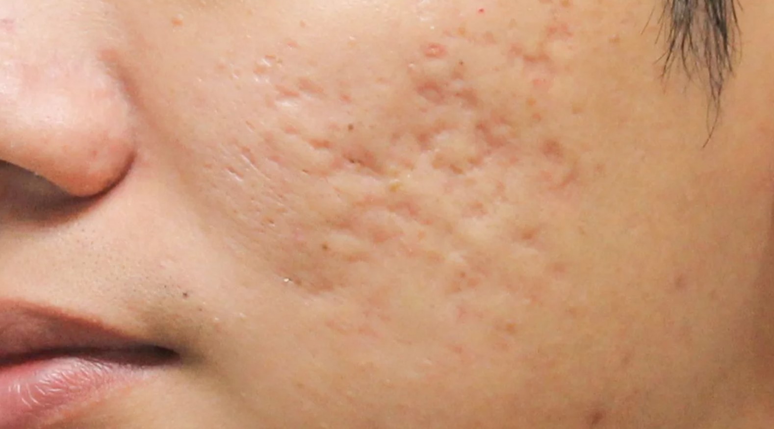 Does Red Light Therapy Help Old Scars? [2024] InfraredGlow