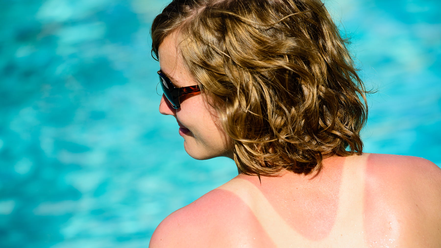 Does Red Light Therapy Help Sunburn?
