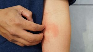 Does Red Light Therapy Work for Eczema?