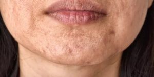 Is Red Light Therapy Good for Keloid Scars?