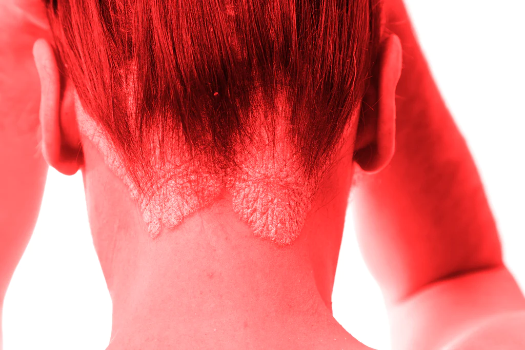 Best Red Light Therapy Device For Psoriasis