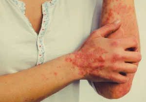 Best Red Light Therapy Device for Eczema