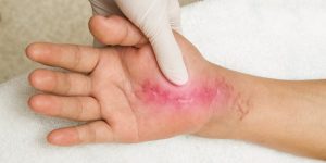 Can You Use Red Light Therapy on Open Wounds?