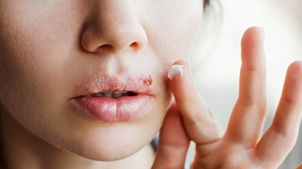 What are Cold Sores?