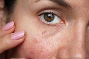 Does Red Light Therapy Help Broken Capillaries?