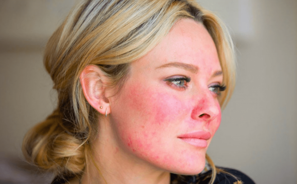 What Color Light Therapy for Rosacea?
